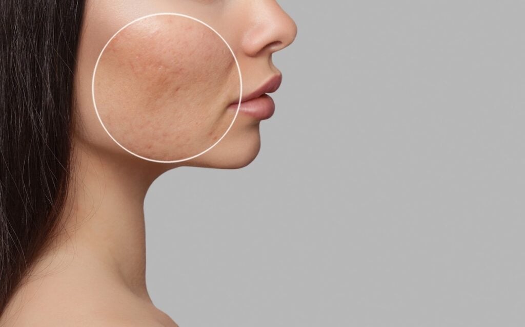 Acne Removal Dubai: Expert ...